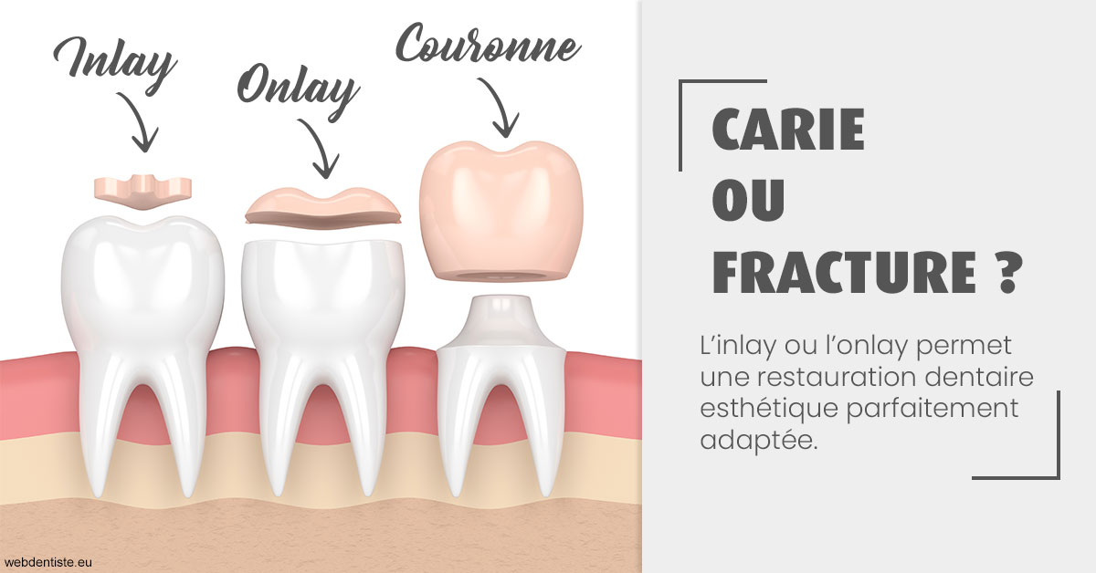 https://selarl-cabinet-docteur-bertrand.chirurgiens-dentistes.fr/T2 2023 - Carie ou fracture 1