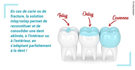 https://selarl-cabinet-docteur-bertrand.chirurgiens-dentistes.fr/L'INLAY ou l'ONLAY