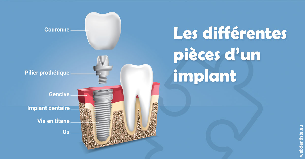 https://selarl-cabinet-docteur-bertrand.chirurgiens-dentistes.fr/Les différentes pièces d’un implant 1